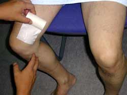 内転筋の異常による膝部痛 １ テーピングの仕方