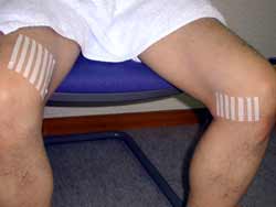 内転筋の異常による膝部痛 ２ テーピングの仕方