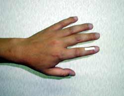 突き指又は指関節痛 テーピングの仕方